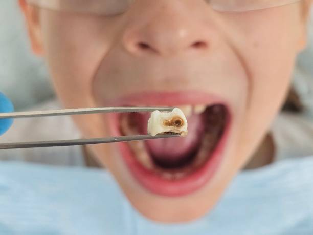 Best Emergency Wisdom Teeth Removal in Warsaw, NC